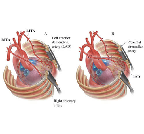 Total Arterial CABG