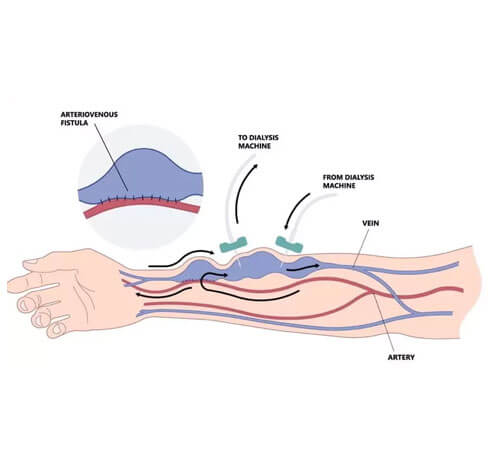AV Fistula