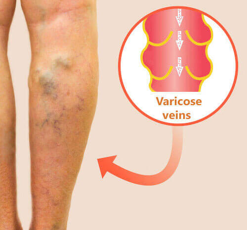 Varicose Veins