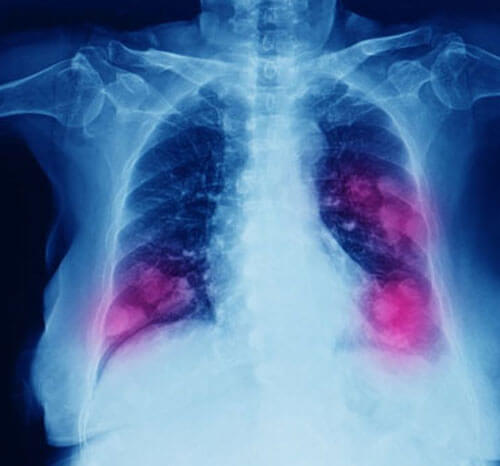 Lung and Thoracic Surgery