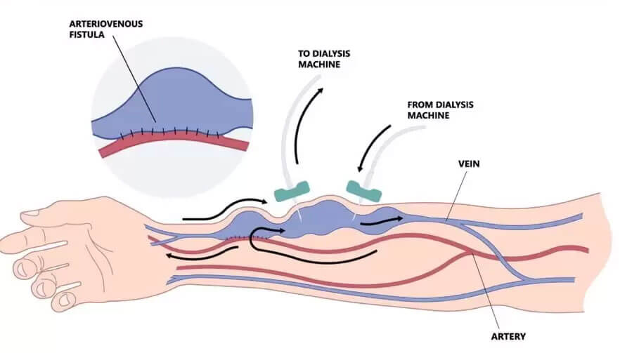 AV Fistula Surgery