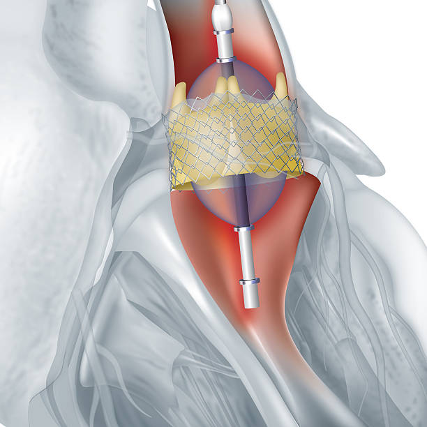 Valve Replacement Surgery