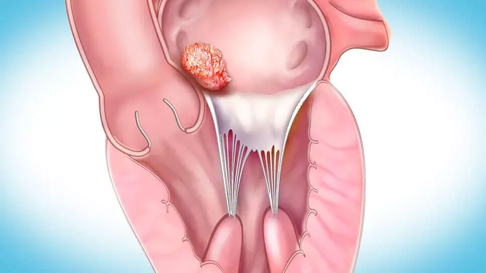 Cardiac Tumour Surgery