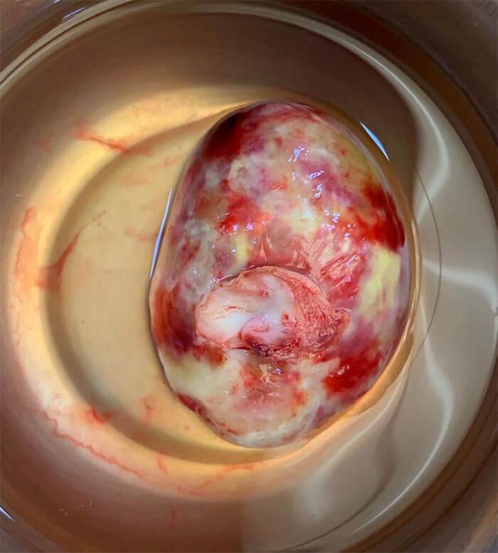 Cardiac Tumour Surgery