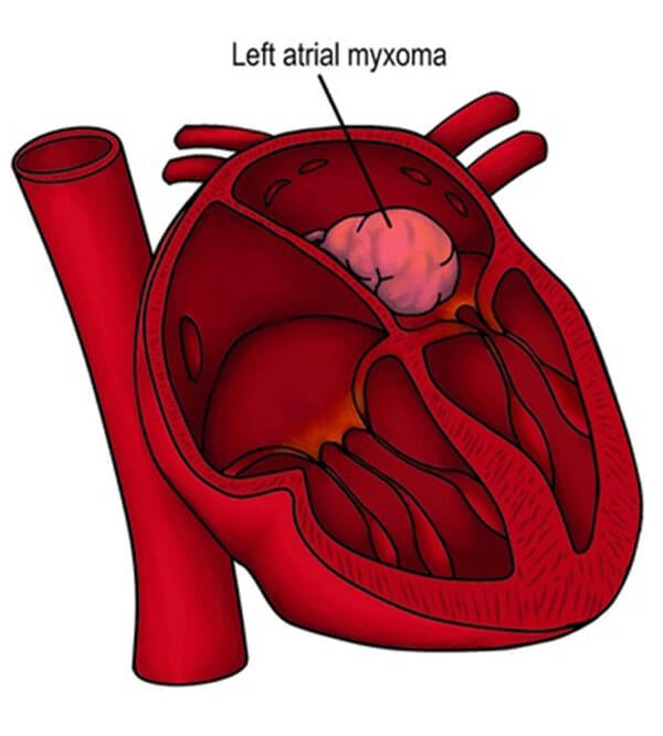 Cardiac Tumour Surgery