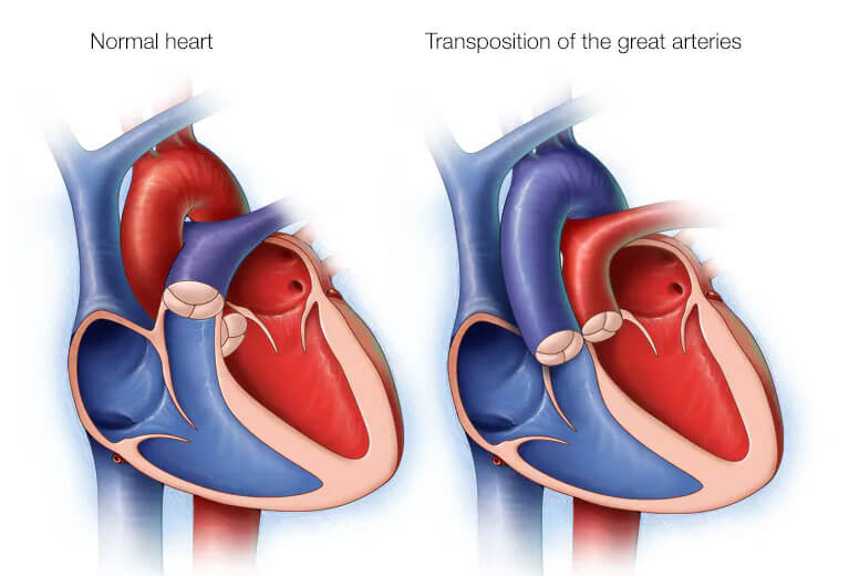 Congenital Heart Defects