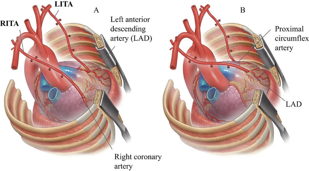 Coronary Artery Bypass Grafting Surgery