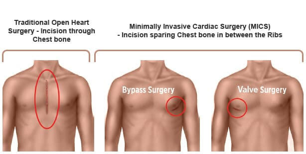 Minimally Invasive Heart Surgery