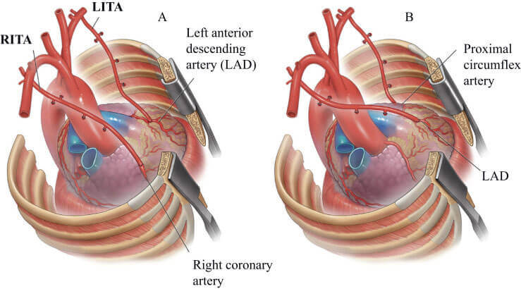 Beating Heart and Total Arterial Bypass Surgery