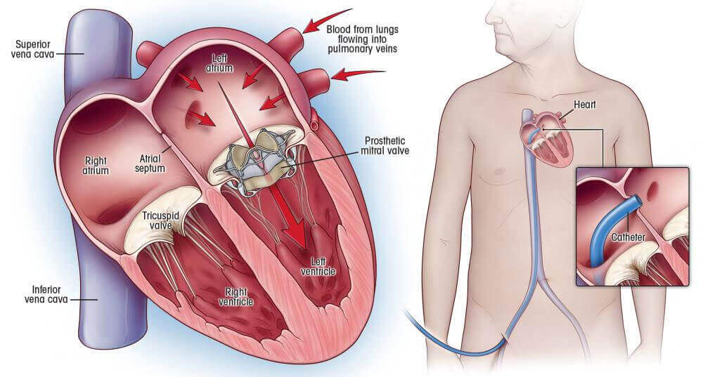 Heart Valve Surgery