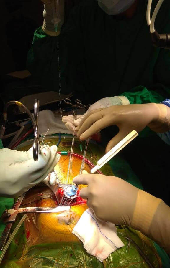 Valve Replacement Surgery