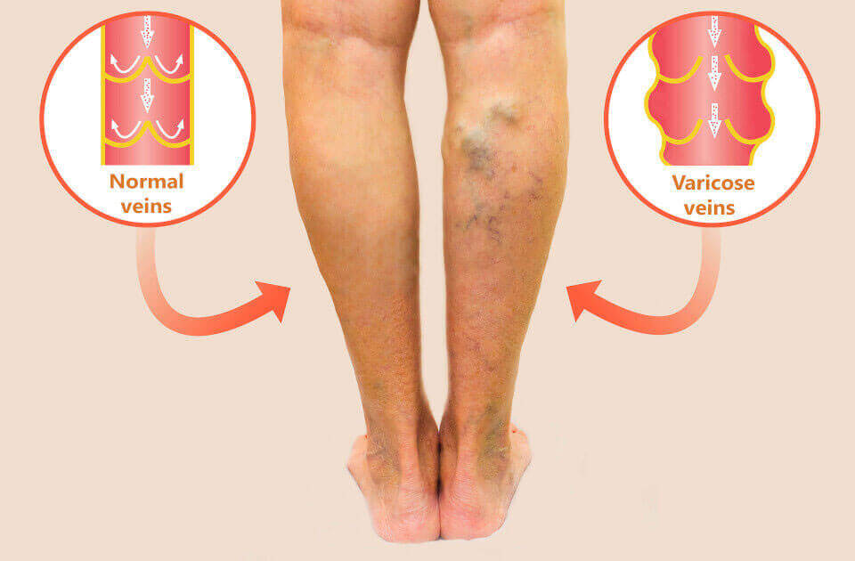 Varicose Veins Treatment