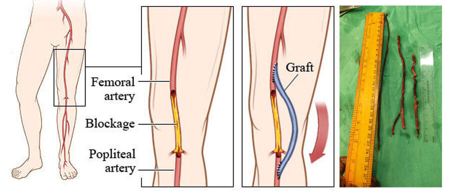Vascular Surgery