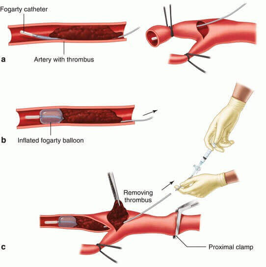 Types of Vascular Surgery