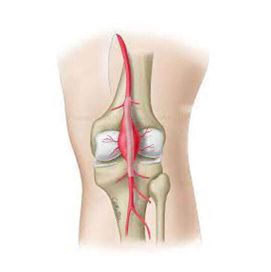 Types of Vascular Surgery